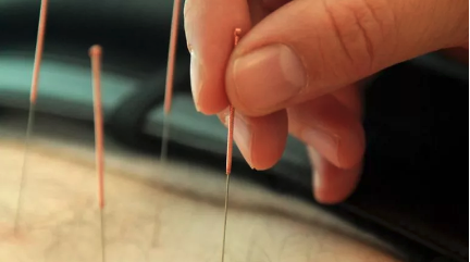 Acupuncture shown to help veterans with PTSD Acupuncture shown to help veterans with PTSD